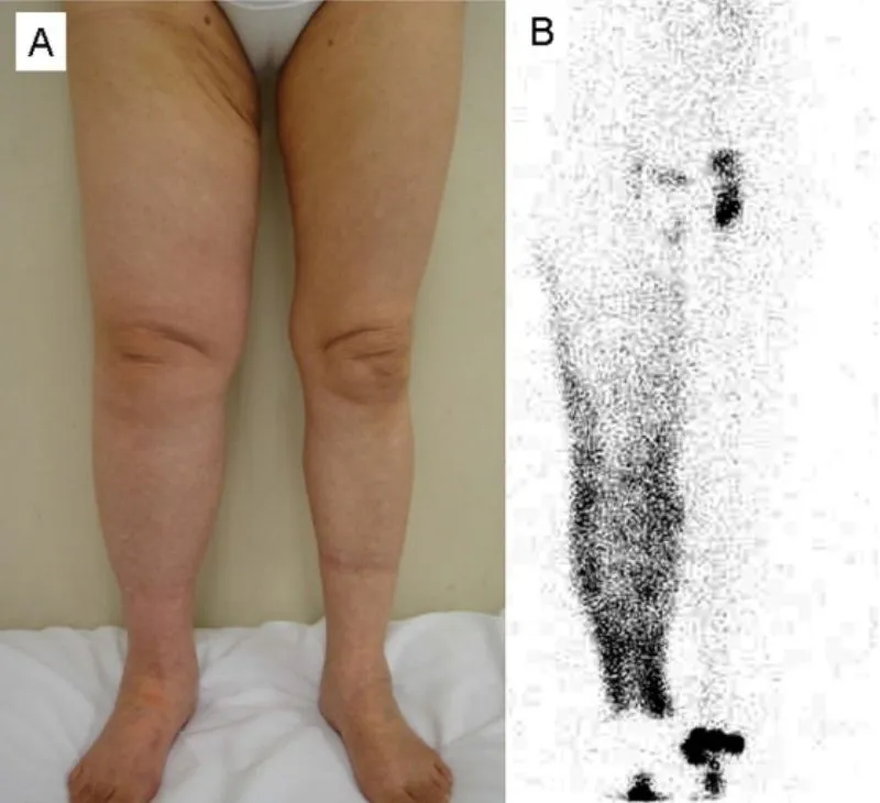 Two-panel medical image: swollen legs beside a scan showing dark leaking spots throughout the leg
